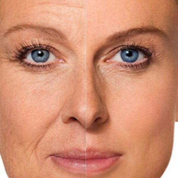 Rejuvenescimento Facial